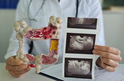 Cáncer de apéndice
