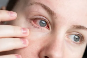 ojos rojos infección alergias